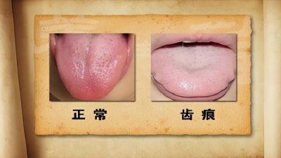​舌边有齿痕，两味药泡茶可缓解！