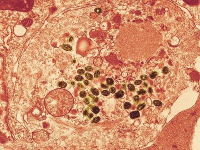 ​人类履历上最恐怖的十大病毒：天花病毒、埃专拉病毒、狂犬病病毒