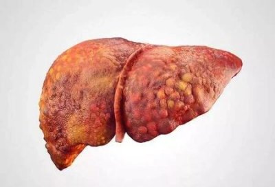 ​肝硬化要吃什么食物可以护肝,养肝呢(肝硬化患者应该如何养肝护肝)