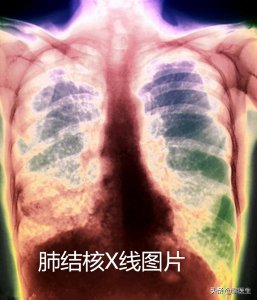 ​肺结核有哪些症状表现用药(肺结核病有哪些症状？服用药物会有什么副作用？)