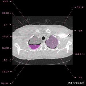 ​肺部CT高清解剖图谱，附带详细标注