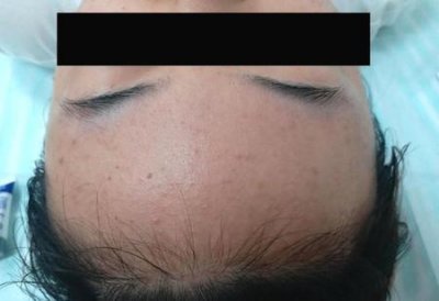 ​脸上长闭口怎么办用什么方法消除(闭口粉刺怎么祛除小妙招)