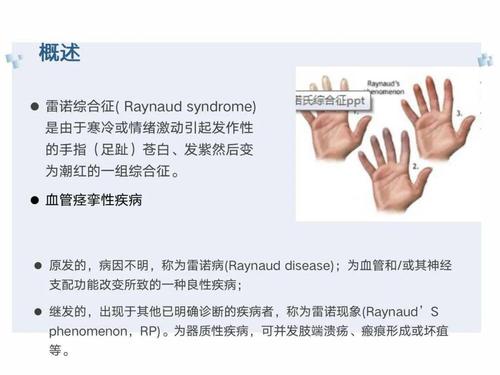 雷诺现象(雷诺现象介绍)